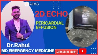 PERICARDIAL EFFUSION2D ECHOAIIMSNEWDELHI [upl. by Sheelagh]