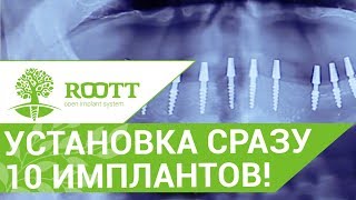 Имплантация всех зубов💉 Как проходит операция по имплантации всех зубов ROOTT [upl. by Annuhsal]