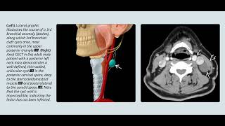 Branchial cystㅣthyroglossal cystㅣthornwaldt cyst radiology [upl. by Karole]