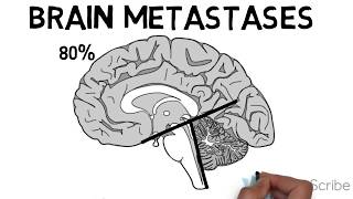 Brain Metastases [upl. by Eirek397]