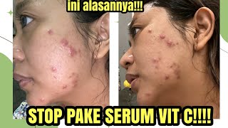 INI ALASAN AKU BERHENTI PAKE SERUM VITAMIN C  JIGLYCIOUSS SKINCARE [upl. by Niklaus278]