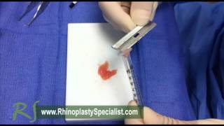 Rhinoplasty Surgical Technique Diced Cartilage [upl. by Jalbert]