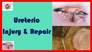 Ureteric Injury and Repair  End to End Ureteric Anastomosis [upl. by Neik]