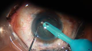 Phaco in soft posterior subcapsular cataract [upl. by Whitford611]