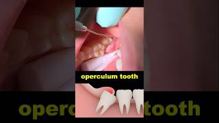 Operculum tooth treatment dentist dentistry wisdomtooth [upl. by Seftton]