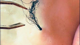 Removal of ingrown hair [upl. by Morty]