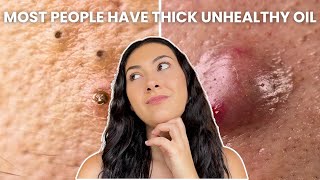 How To Treat Every Type of Acne Comedones Nodules Cysts [upl. by Pavel]