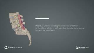 Favorable Results of MagnetOs as Standalone Alternative to Autograft in a Level 1 Clinical Trial [upl. by Everrs]