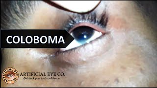 Coloboma Iris and Nystagmus  Anophthalmia  Dr Sumitra [upl. by Enait]