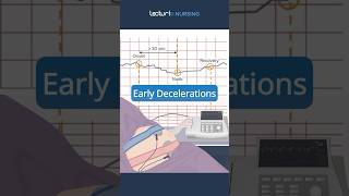 Early Decelerations Explained 🩺 NursingStudents FetalMonitoring [upl. by Denver]