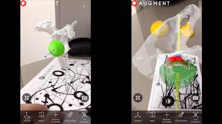 Augmented Reality for Shoulder Surgery [upl. by Lodi98]