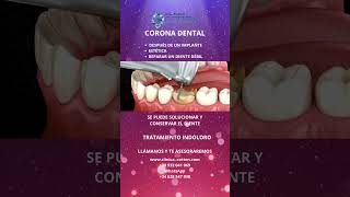 CORONA DENTAL [upl. by Okime]