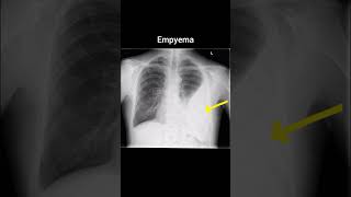 Empyema xray radiology röntgen thorax empyema [upl. by Tihw509]