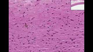 Histopathology AortaAtherosclerosis with fatty streak [upl. by Yendys]