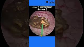 23 mm Kidney Stone treatment  RIRS  Retrograde intrarenal surgery shorts [upl. by Sema]