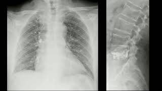 Embolia pulmonar por PVMA [upl. by Norabal]