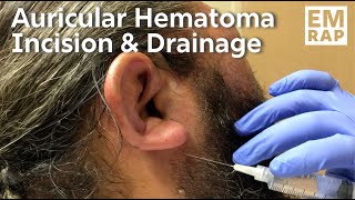 Auricular Hematoma Incision and Drainage with Bolster Compression Dressing [upl. by Mhoj884]