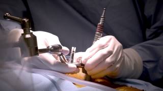 Minimally Invasive Laminectomy Surgery to Treat Lumbar Stenosis  MedStar Southern Maryland [upl. by Jennings]