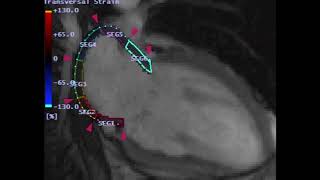 Afib Catheter Ablation Biomarker – Two Chamber View [upl. by Japheth]