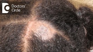 What causes Scalp Ringworm Effective Treatment   Tinea Capitis  Dr Tina Ramachander [upl. by Eillo]