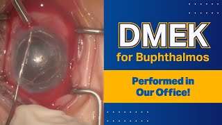 DMEK for Buphthalmos  Performed in Our Office [upl. by Garett]