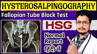 HSG Report Kaise Dekhe  HSG Test Painful Or Not In Hindi  HSG Test Kya Hota Hai  HSG Test Video [upl. by Kutzer]