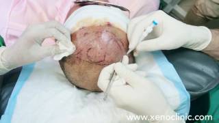 XENO clinic Hair Transplant FUE Cambodian customer ដាំសក់នៅហ្សីុណូគ្លីនិក [upl. by Annalla]