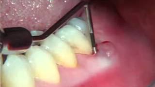 Endodontics Torabinejad 61 Perio of Pulpal Origin [upl. by Hirsh]