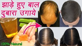 बालों को मोटा करें गंजेपन और बालो का गिरना कम करें Remedy for Hair Fall amp Baldness [upl. by Ivonne]