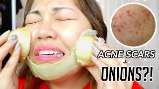 Get Rid of ACNE SCARS with ONIONS [upl. by Aisekal598]