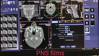 How can print CT PNS filmsSiemens healthineers SOMATOM go CT Scan [upl. by Irme]