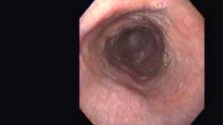 Achalasia Vs Pseudoachalasia [upl. by Simons]