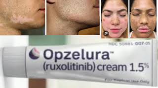 Opzelura ruxolitinib cream [upl. by Rekoob]