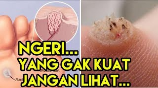 Cara Mengatasi Mata Ikan Dengan Cepat Dan Aman [upl. by Danila]