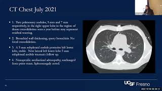 Central Valley Chronicles Challenging Coccidiomycosis Cases in PWH [upl. by Levi]