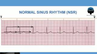 Ritmo Sinusal Normal  Calculo de Frecuencia Cardiaca [upl. by Solracnauj]