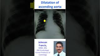 Dilatation of ascending aorta [upl. by Fowle]