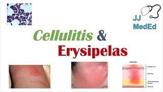 Cellulitis vs Erysipelas  Bacterial Causes Risk Factors Signs and Symptoms Treatment [upl. by Arnuad]