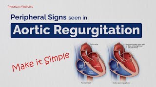 Making Bedside Diagnosis Easy Peripheral Signs in Aortic Regurgitation [upl. by Gerta]