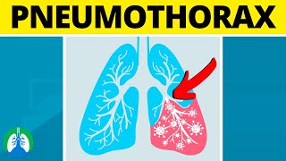 Pneumothorax Medical Definition  Quick Explainer Video [upl. by Eatnhoj257]