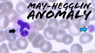 MayHegglin Anomaly Döhle bodylike inclusions amp giant platelets Hematology amp Hematopathology [upl. by Yekciv]