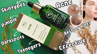 Acne serum  Rivaj uk acne treatment serum  serum for acne  Acne and pimple solution [upl. by Anaile841]