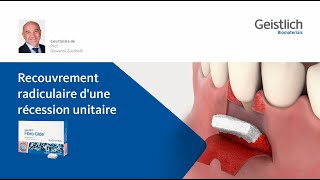 Recouvrement radiculaire dune récession unitaire [upl. by Navak]