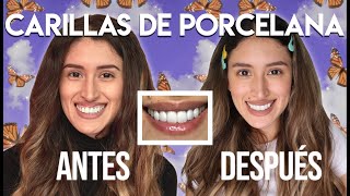 Carillas Dentales de Porcelana Antes y Después Mi Experiencia Paso a Paso y Más [upl. by Lymn952]