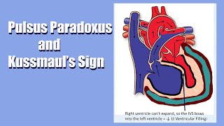 Pulsus Paradoxus amp Kussmauls Sign A Sign of Heart Trouble A Live Lecture [upl. by Lenehc]