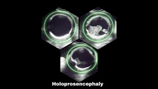 Holoprosencephaly [upl. by Engel]