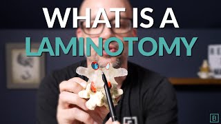 What is a Laminotomy  Spine Surgery Basics [upl. by Tayyebeb]