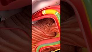 Thrombectomy machanical shorts medical science health nursingking [upl. by Proudfoot]