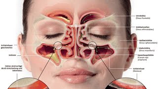 Chronische Sinusitis maxillaris [upl. by Veta]