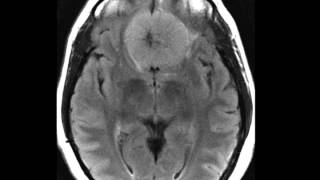 Meningioma Planum Sphenoidale [upl. by Steinberg823]